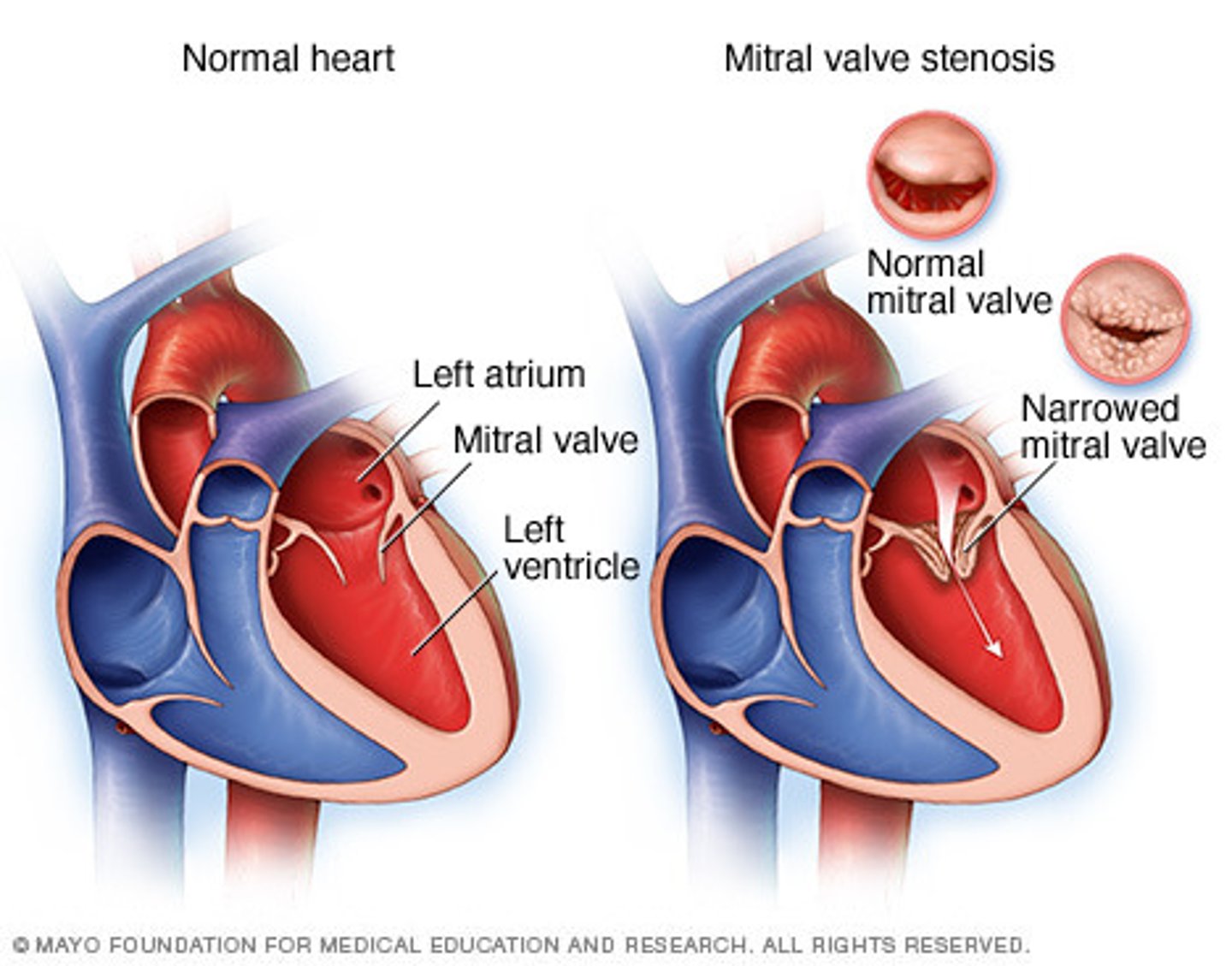 <p>Description: Valve with two cusps between the left atrium and ventricle</p><p>Relationship: The order of the Tricuspid and Bicuspid valves can be remembered by "Try before you Buy"</p>