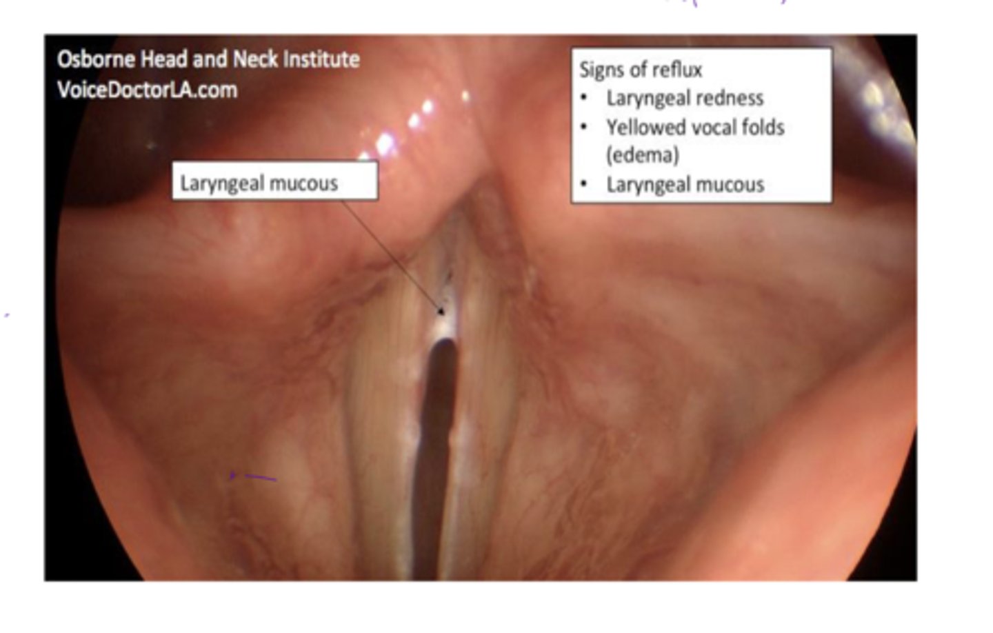 <p>laryngeal redness</p><p>yellowed vocal folds (edema)</p><p>laryngeal mucous</p>