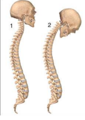 <p>def. an arthritic like condition along the vertebral column that causes a painful huckaback</p>