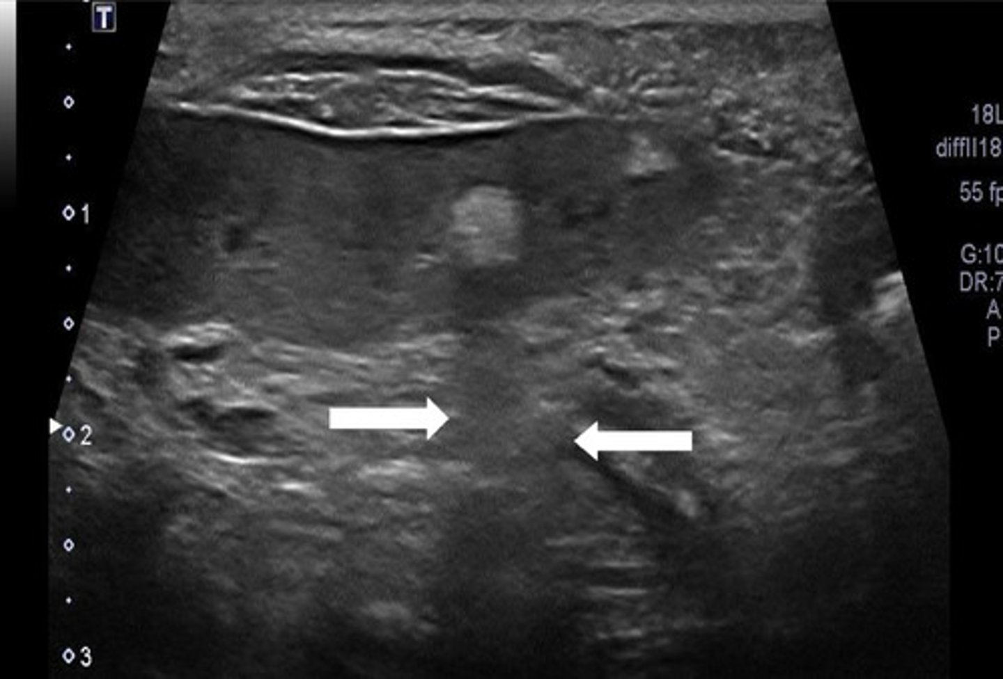 <p>what are the arrows indicating? (there is a mass in this spleen)</p>