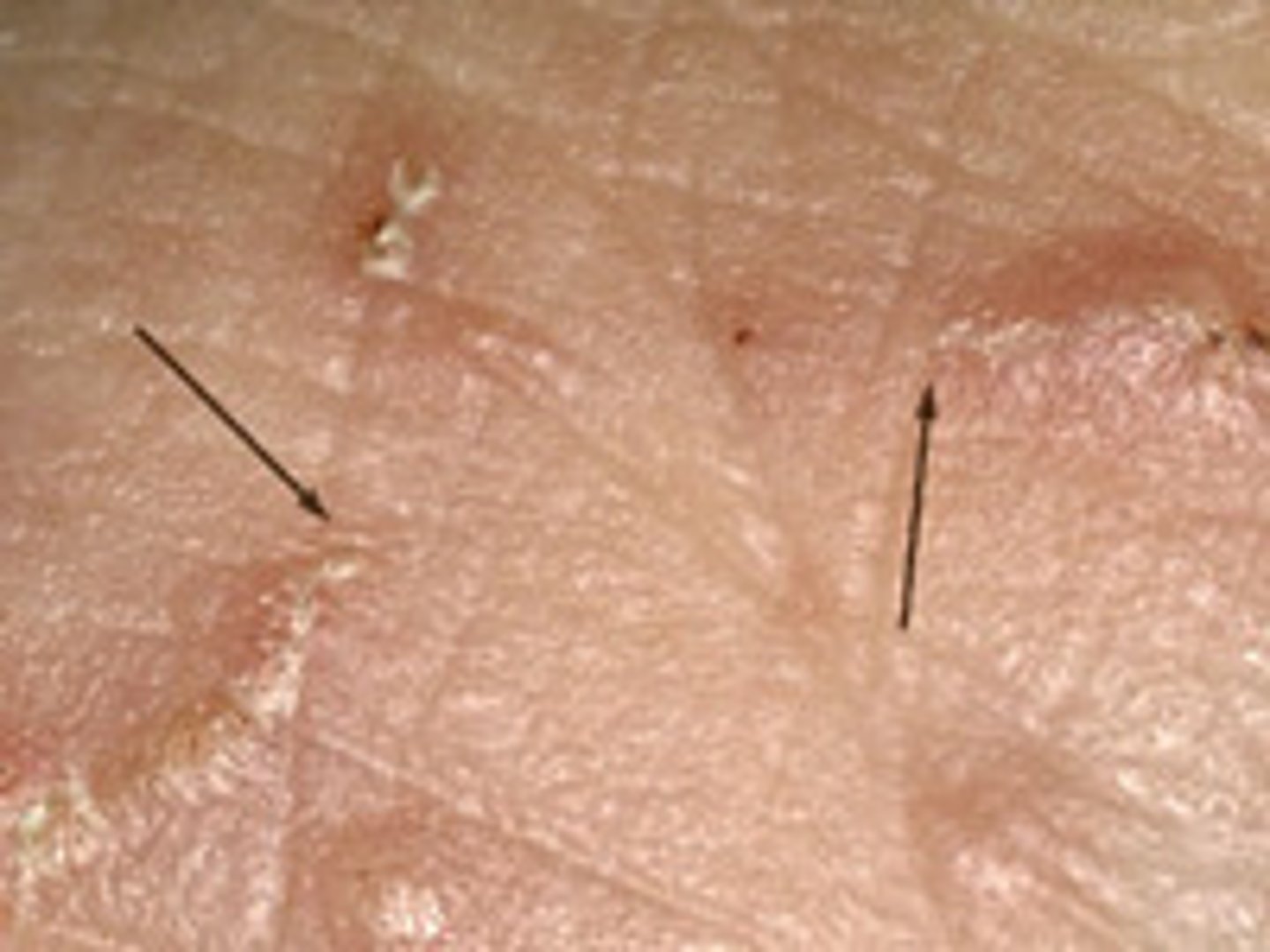 <p>Small linear or serpiginous pathways in the epidermis created by the scabies mite</p>