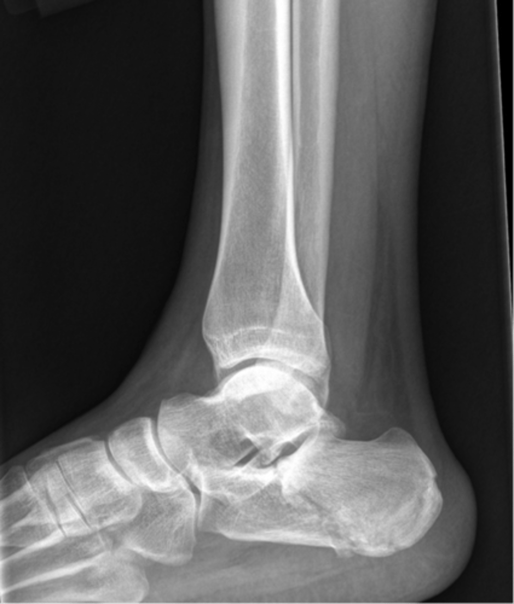 <p>- AKA "lover's fracture"; usually the result of a fall from height.</p>