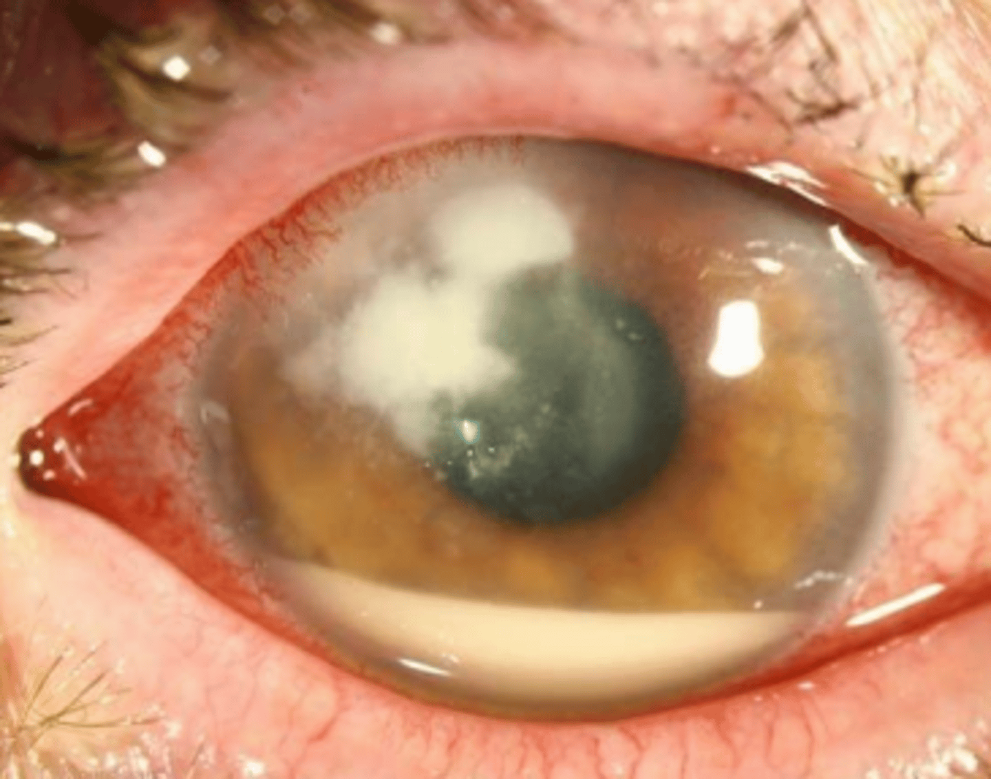 <p>sedimentation of white blood cells in the inferior aspect of the anterior chamber. Is graded by its height in mm, or by the percentage of anterior chamber involved. Can be caused by inflammation, infection, trauma, tumors. Is managed with anti-inflammatory and anti-infective agents.</p>