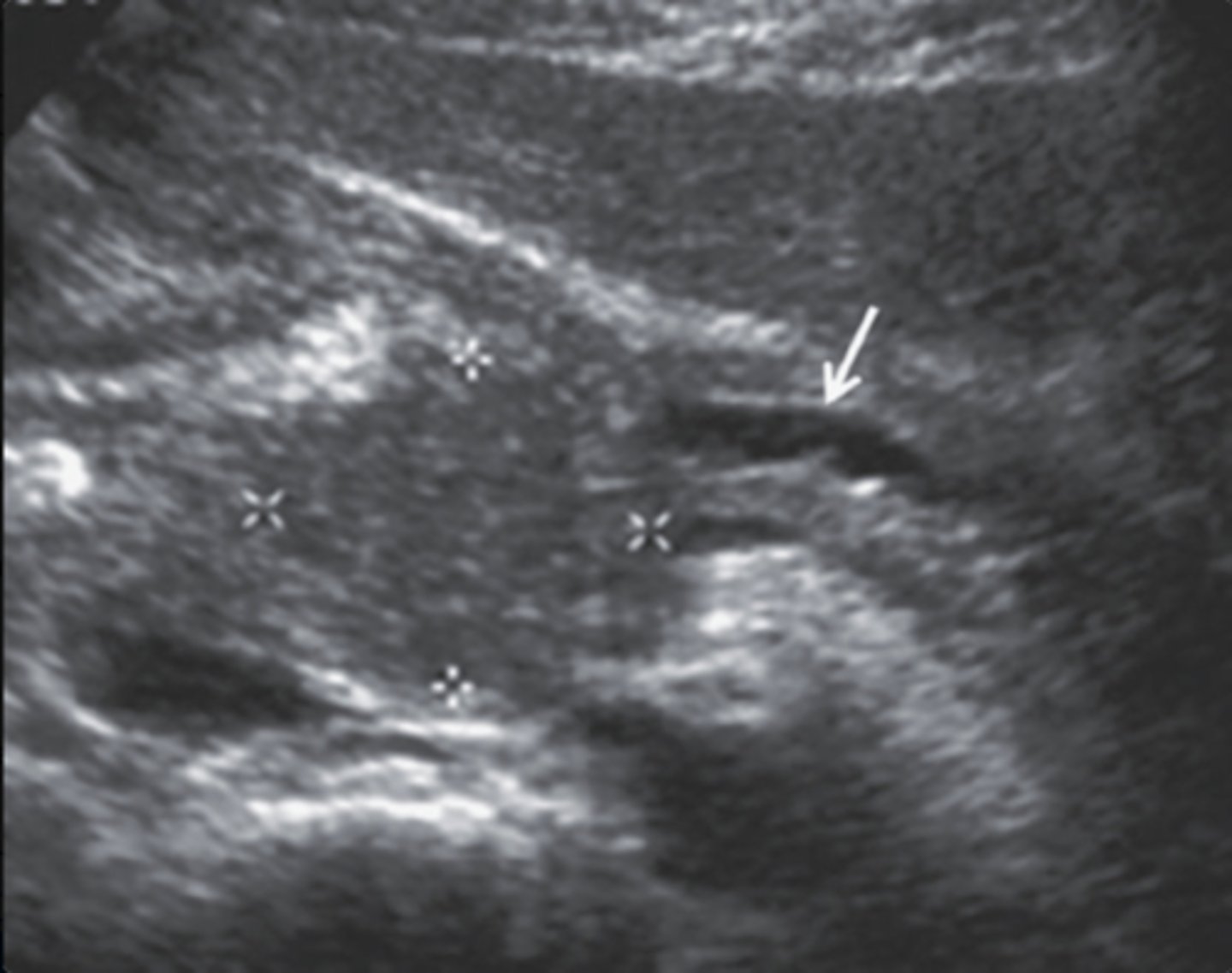 <p>a. Pancreatic adenocarcinoma</p>