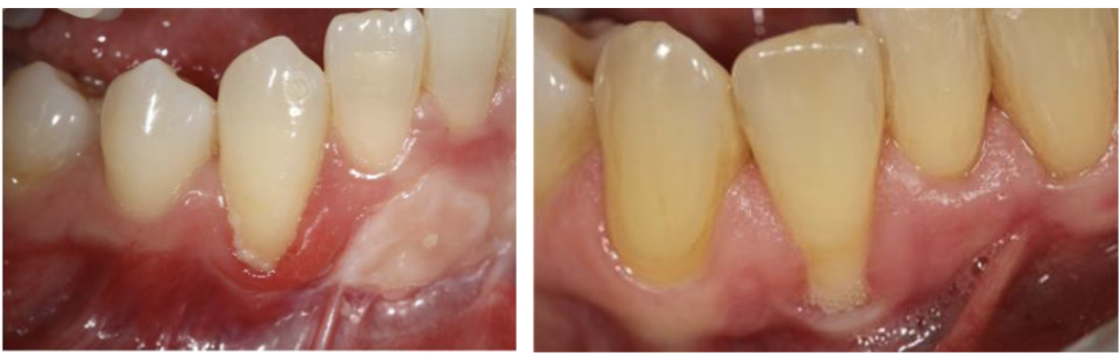 <p><span>Labially positioned tooth (inherited/acquired through orthodontic movement)</span></p>