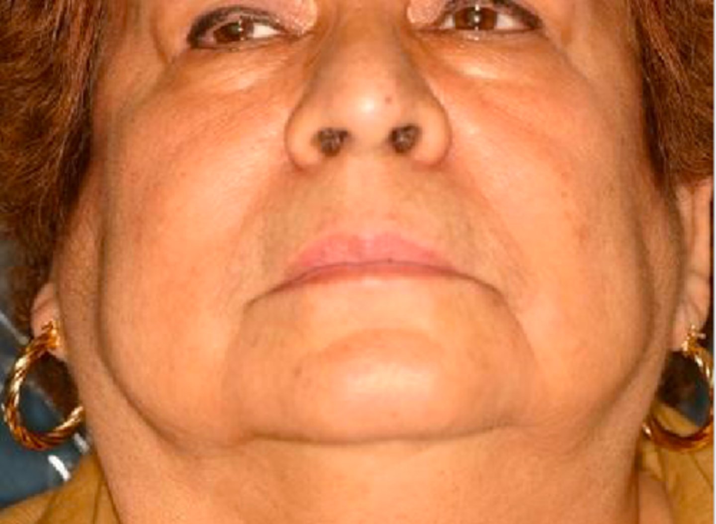 <p>Patient presents to your office complaining of xerostomia and dysphagia. Patient admits that they also experience dry eyes. Patient also has numerous cervical caries, fissured tongue with atrophy of papillae, and a minor case of secondary candidiasis. Upon physical examination, you notice bilateral swelling of the parotid glands. Lab work up shows elevated IgG, positive rheumatoid factor (RF) and Antinuclear antibodies (ANA). What is the diagnosis?</p>