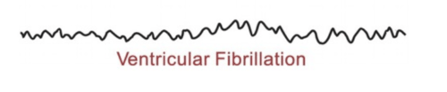 <p>Uncoordinated ventricular depolarizations</p>