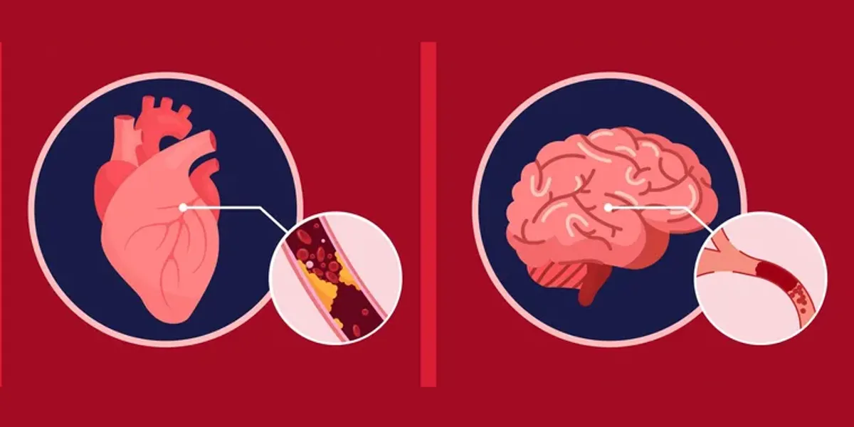 <ul><li><p>Chronic elevated levels of glucose can lead to <strong>damage of the blood vessels</strong> by promoting the formation of <strong>plaques</strong> (atherosclerosis), which narrow and harden the arteries. </p></li><li><p>This increases the risk of <strong>heart attack</strong> and <strong>stroke</strong> by restricting blood flow and raising blood pressure.</p></li></ul><p></p>