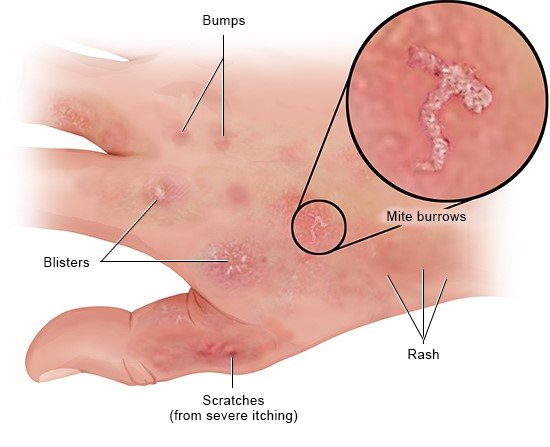 <p>skin condition caused by microscopic mites (Sarcoptes scabiei car. hominis) that burrow into skin. highly contagious and spreads through direct contact. if left untreated, leads to bacterial skin infections </p>