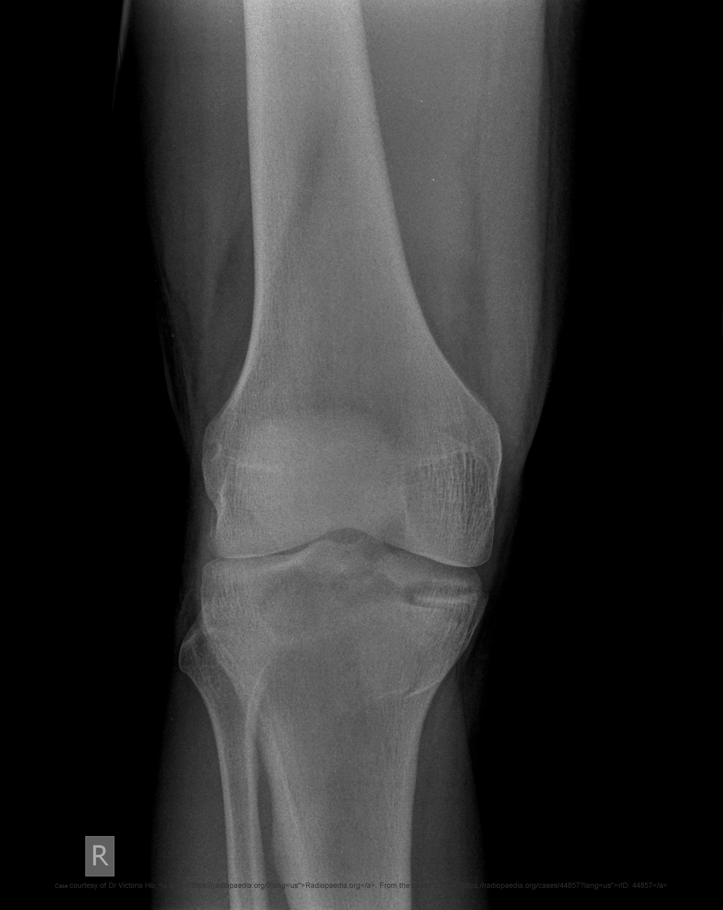 <p>What commonly causes tibial plateau fractures?</p>