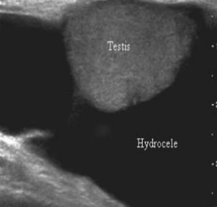 <p>hydroceles are a collection of _____ fluid with painless swelling<strong>, and </strong>commonly associated with epididymo-orchitis and torsion</p>