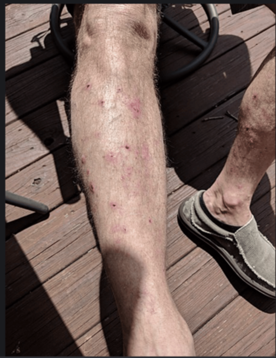 <p>- autoimmune blistering skin condition characterised by flaccid intra-epidermal blisters</p><p>- IgG autoantibodies are targeted against desmosomes: structures that link keratinocytes to other keratinocytes within the epidermis</p><p>- The specific antigens are desmoglein 1 and desmoglein 3</p><p>- Nikolsky sign positive</p>
