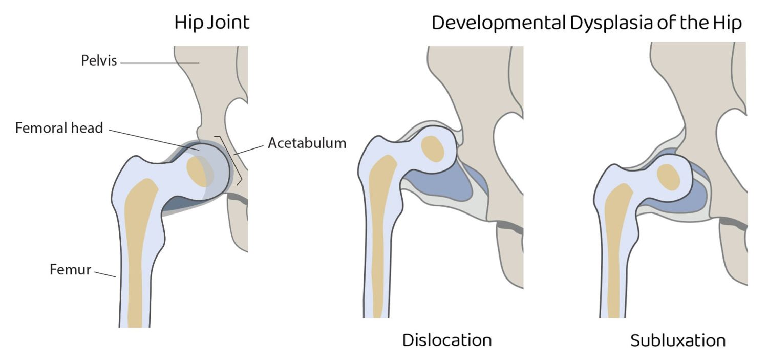 <p>dysplasia of acetabulum </p>