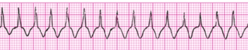 <p>Supraventricular tachycardia criteria</p>
