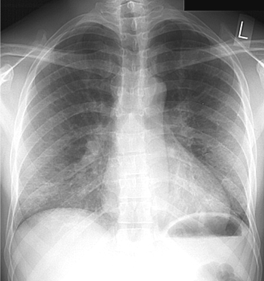 <p>is a type of pneumonia caused by the fungus Pneumocystis jirovecii, primarily affecting immunocompromised individuals. Evolves from a normal CXR to an interstitial pattern to an alveolar pattern. </p>