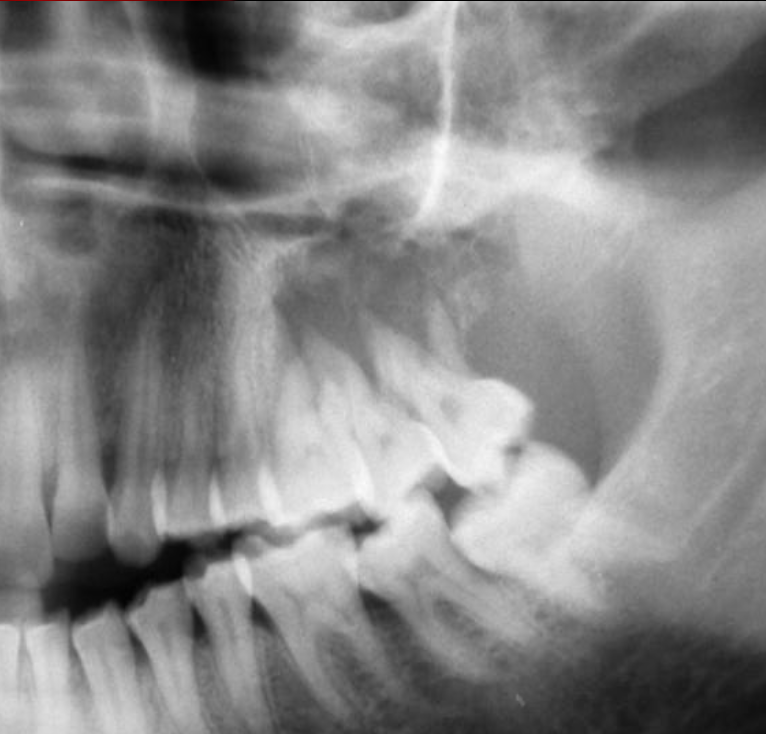 <p>How would you describe odontogenic myxoma radiographically?</p>