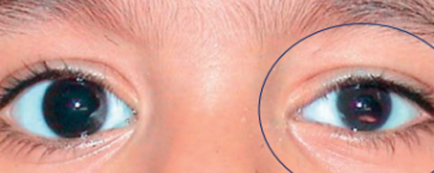 <p>an arrest of ocular growth (unilateral or bilateral) leading to total axial length 2+ standard deviations below the age similar controls. Results from a developmental problem of the globe at any stage of growth of the optic vesicle after week 4 of embryological development.</p>