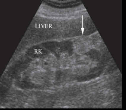 <p>What does the following sonographic appearance describe?</p><p><span>• They are small well defined sub capsular</span><br><span>Isoechoic or hypoechoic or echogenic</span><br><span>cortical mass usually 3cm.</span><br><span>• Vascular and attenuates sound</span></p>