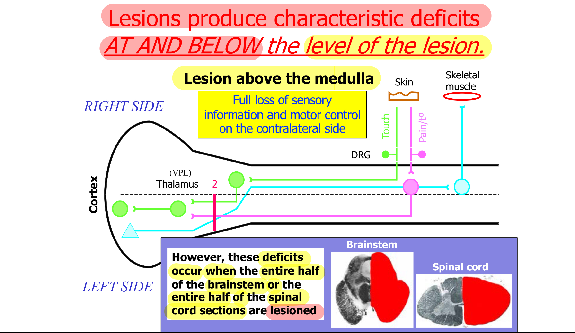 <p><strong>Full loss</strong> of sensory information and motor control on the <u>contralateral</u> side</p>