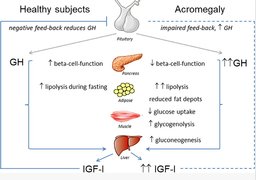 <p>hypersecretion of somatotropin during childhood</p><p>over production of growth hormone throughout development </p><p>excessive amount of growth hormone in adulthood</p><p></p><p>causes = thickening of bones in hands, feet, cheeks, jaws (happens in adults) </p>