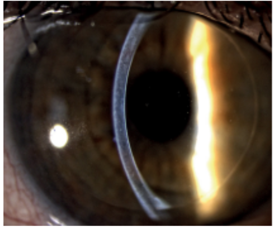 <p>what slit lamp technique is being demonstrated in the image&nbsp;</p>