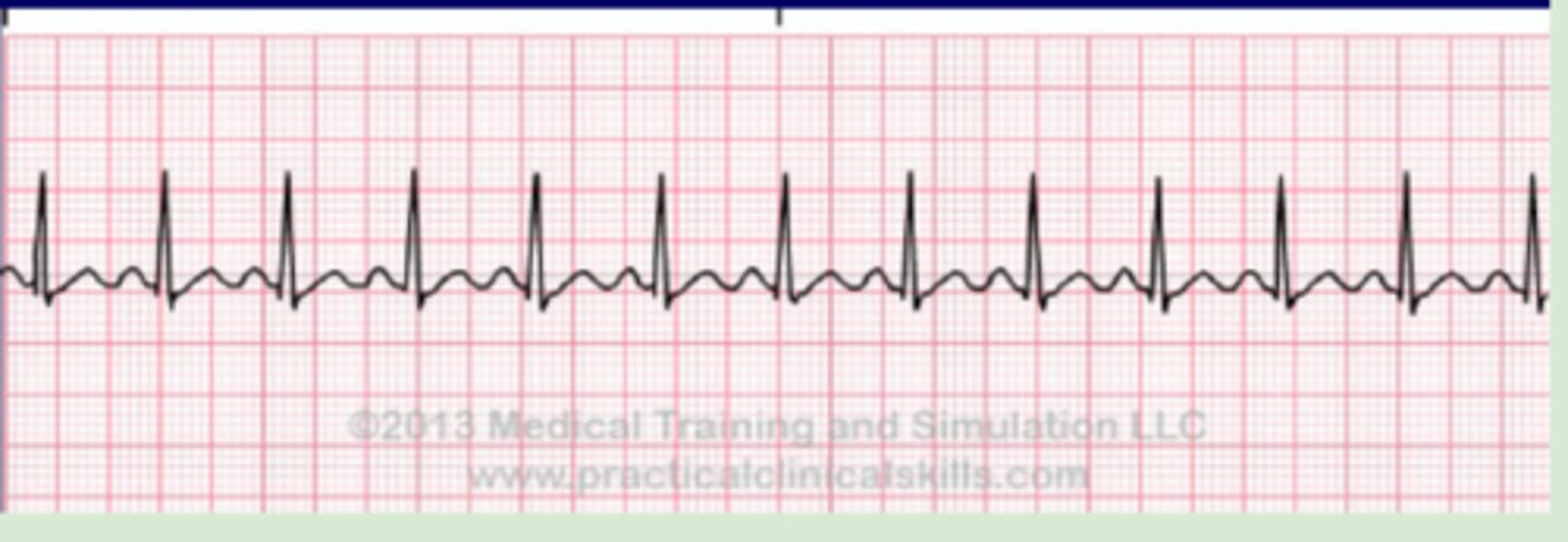 <p>Originate: SA node</p><p>QRS complex: narrow</p><p>P wave: before QRS, same</p><p>Heart rate: &gt;100 bpm</p><p>R-R intervals: regular</p>