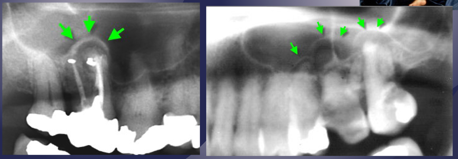 <ul><li><p>elevation/displacement of floor f maxillary sinus </p></li><li><p>maxillary posterior teeth </p></li></ul><p></p>
