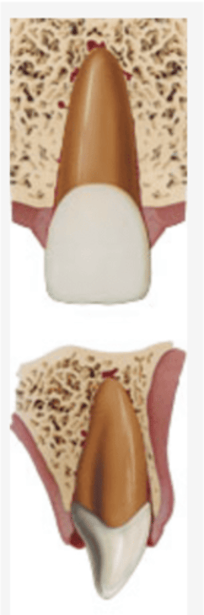 <p>Definition:</p><p>•Apical displacement of tooth into the alveolar bone</p><p>•Tooth is driven into the socket, compressing the PDL</p><p>•Tooth appear to be shortened or missing</p><p>•Severe type of luxation injury</p>