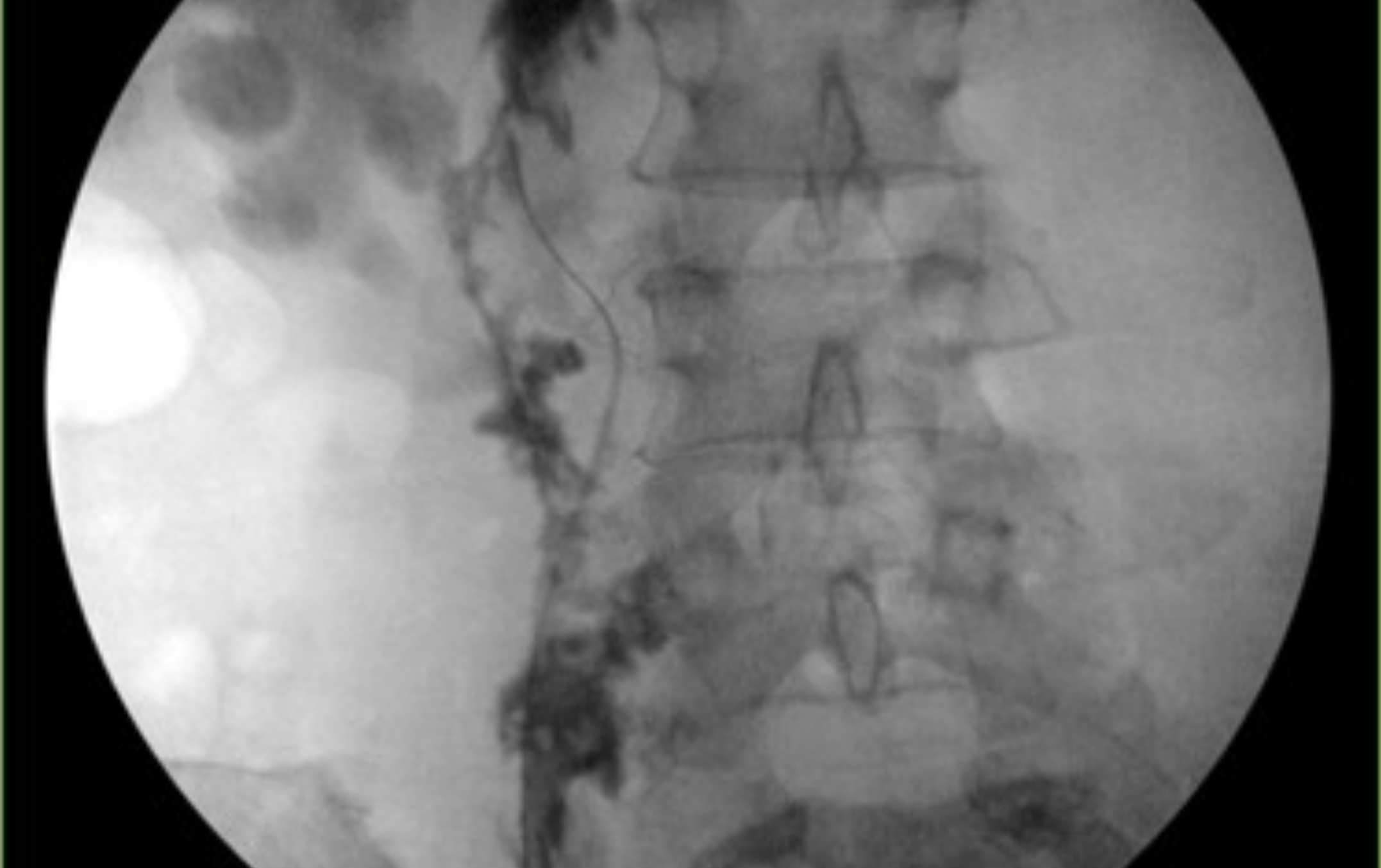 <p>What does this retrograde pyelogram show?</p>