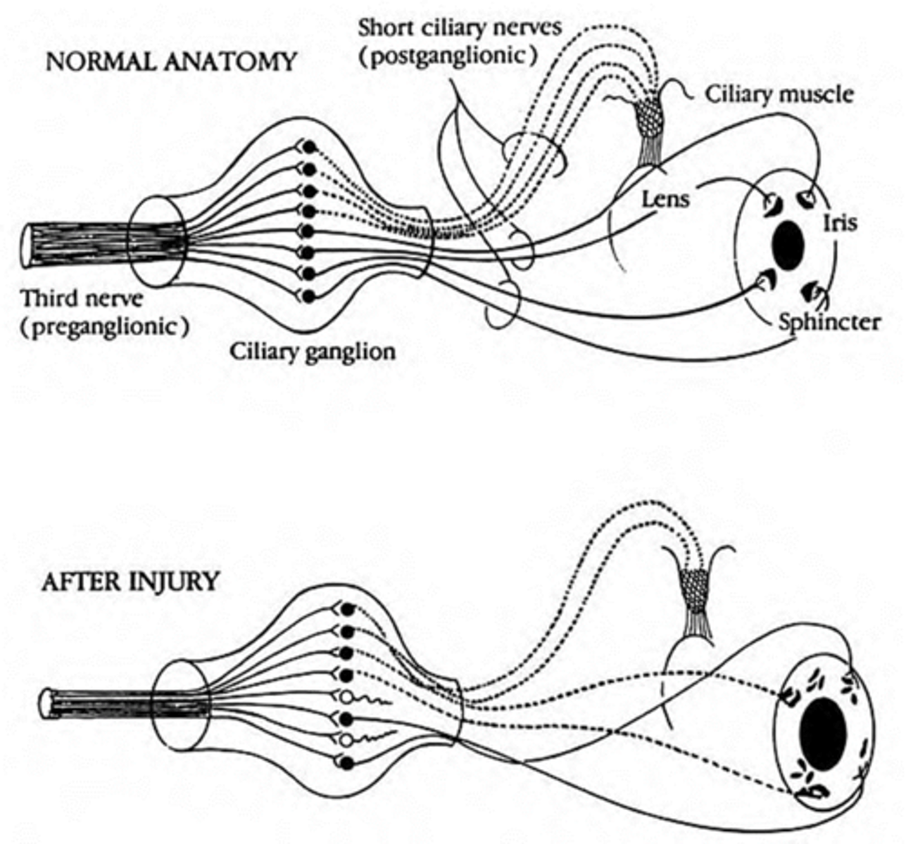 <p>ciliary ganglion damage and recovery = nerve axoplasm that once went to accom now goes to pupil = pupillomotor fibers innervated by accom fibers = pupil still reacts to near</p>