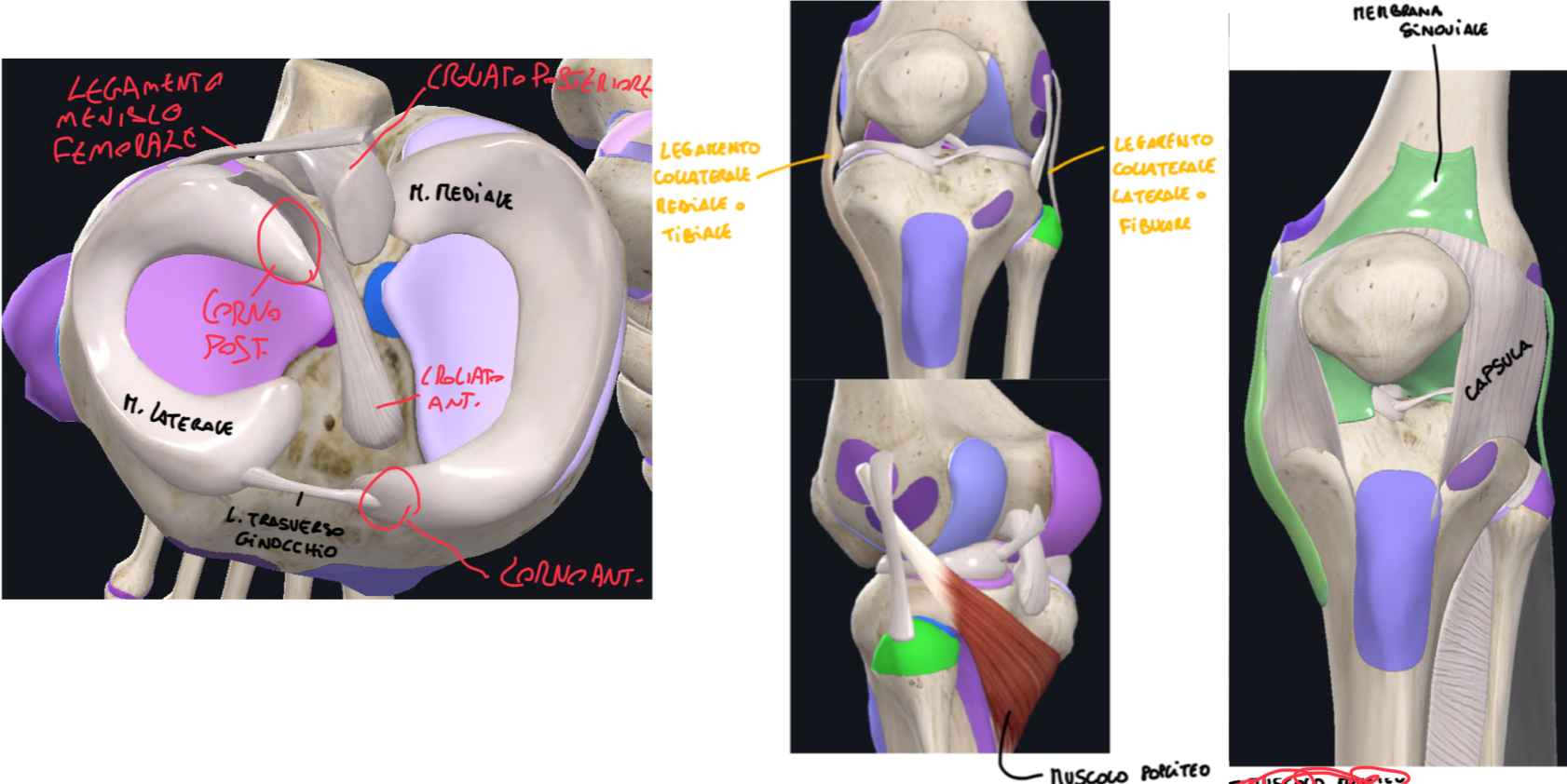 <p>Sono due dischi fibrocartilaginei semilunari, presenti tra le superfici articolari incongruenti (femore e tibia)</p><p>In generale:</p><ul><li><p>Forma a cuneo, più alti al margine laterale, superficie superiore concava e inferiore piatta</p></li><li><p>I corni anteriori e posteriore sono rispettivamente nell’area intercondiloidea anteriore e posteriore della tibia</p></li><li><p>Tra i due menischi anteriormente abbiamo il Legamento Trasverso del Ginocchio, che ne limita i movimenti</p></li></ul><p>Menisco mediale:</p><ul><li><p>Forma di C, semicircolare, perché le estremità sono più distanziate</p></li><li><p>Aderente a Capsula Fibrosa e Legamento Collaterale Mediale → poiché più aderente, è meno mobile, quindi è il più lesionato</p></li></ul><p>Menisco laterale:</p><ul><li><p>Forma di O, circolare, perché le estremità sono più ravvicinate</p></li><li><p>Dal corno posteriore origina il Legamento Menisco-Femorale, che accompagna il legamento crociato posteriore fino al condilo mediale del femore.</p></li><li><p>E’ più mobile, perché non aderisce alla capsula ed è separato dal legamento collaterale laterale dal tendine del muscolo popliteo.</p></li></ul><p></p>