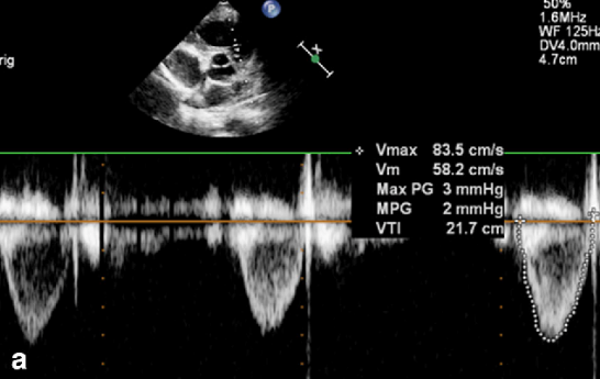 <p>Identify the spectral Doppler waveform:</p>