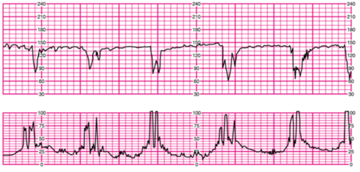 <p>Abrupt deceleration; onset to nadir <30 seconds; complicated and uncomplicated</p>