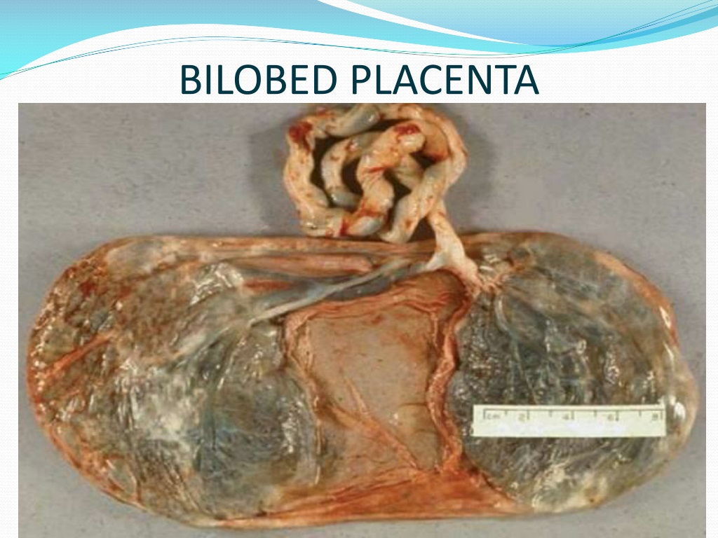 <p>Placenta Bilobata (Bilobed Placenta)</p>