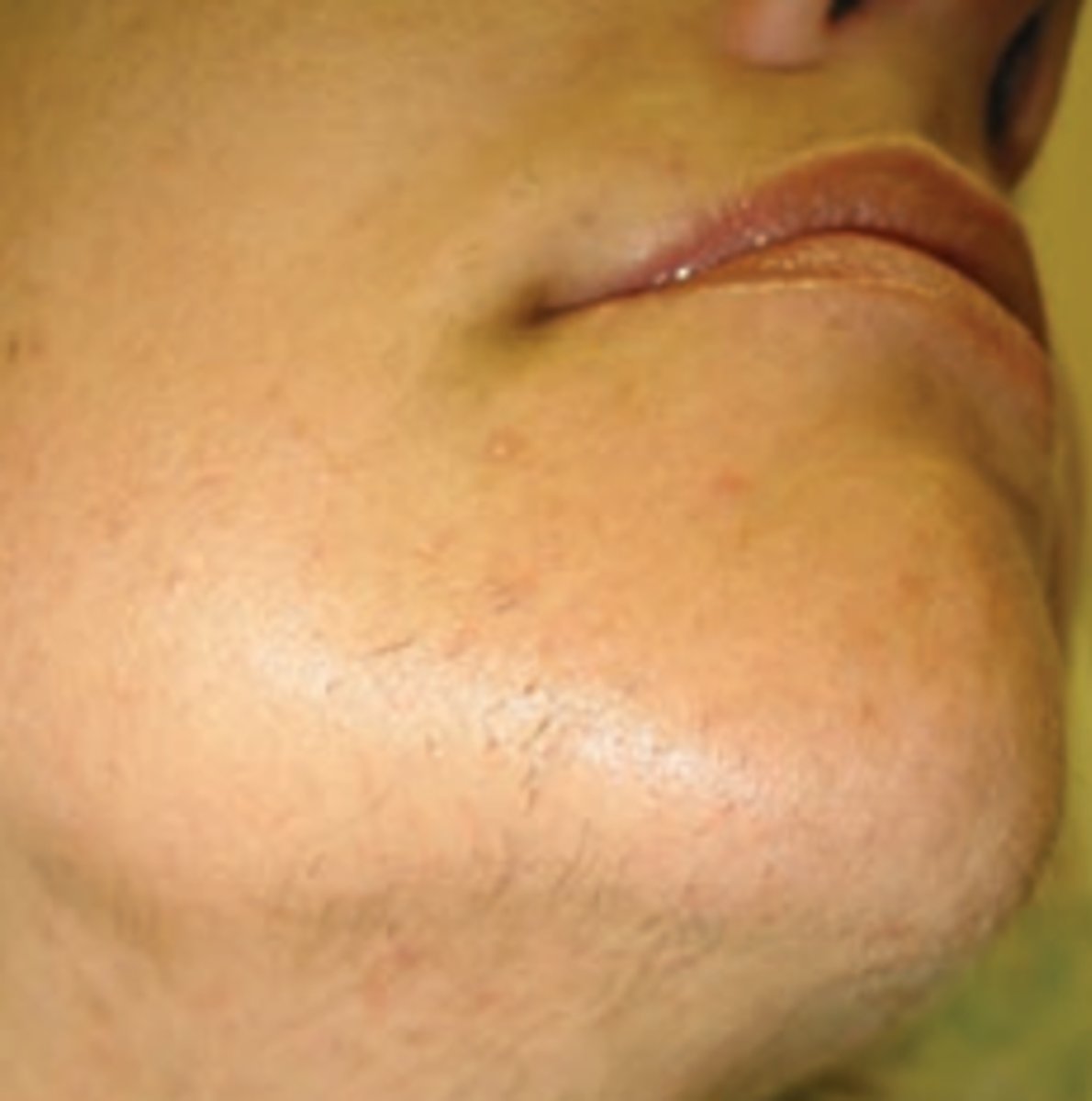 <p>Common in PCOS where more androgen hormones are produces.</p>