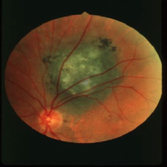 <p>what is the concern for this being melanoma? </p>