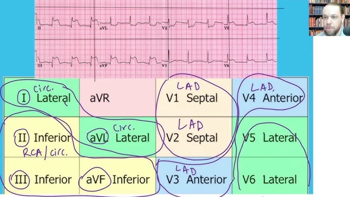 <p>Leads:</p><p>II, III, aVF</p>