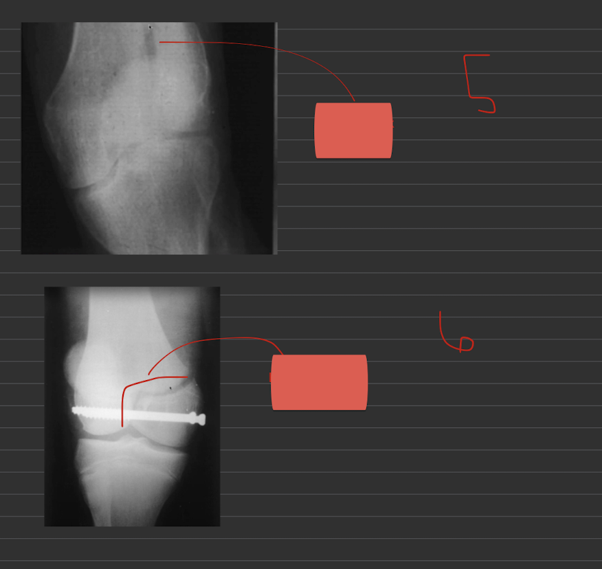 <p>Name thes fractures:</p><ul><li><p>5:</p></li><li><p>6:</p></li></ul><p></p><p></p>