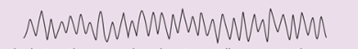 <p>- 8-13 Hz</p><p>- Awake and resting with eyes closed and mind wandering</p><p>- Suppressed when eyes open or performing a mental task, absent during sleep</p>