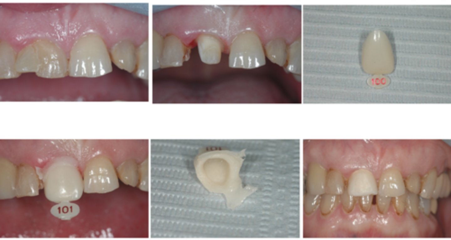 <p>Which temp fabrication technique is shown here?</p>