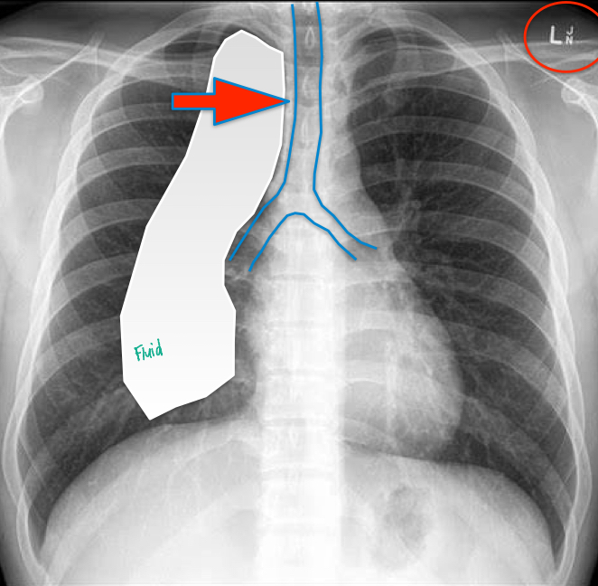 <p>Trachea deviated away from itself &amp; the affected lung</p>