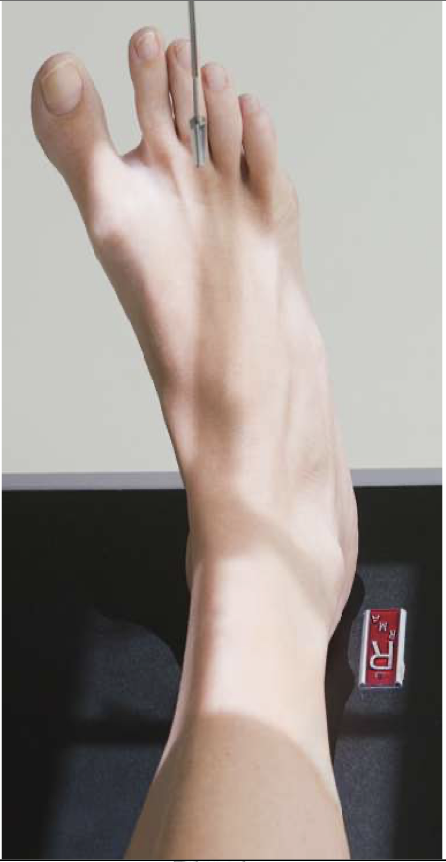 <p>Patient Position   </p><p class="p1"><span style="line-height: normal;"><span> </span></span>Same as AP </p><p class="p1"></p><p class="p1">Part Position</p><p class="p1"><span style="line-height: normal;"><span> </span></span>Foot is not dorsiflexed, allow it to remain extended (visualize the base of the 5<span style="line-height: normal;"><span>th</span></span> MT).</p><p class="p1"><span style="line-height: normal;"><span> </span></span>Entire lower limb is rotated 15-20<span style="line-height: normal;"><span>◦ </span></span>to place intermalleolar line parallel to IR</p><p class="p1"></p><p class="p1">CR</p><p class="p1"><span style="line-height: normal;"><span> </span></span>Perpendicular to midway b/w malleoli</p><p class="p1"></p><p class="p1">Collimation</p><ul><li><p class="p1">Include distal tib/fib (⅓ ) and proximal metatarsals, especially the base of the 5<span style="line-height: normal;"><span>th </span></span>medially </p></li></ul><p></p>