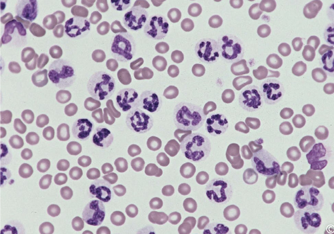 <p>Based on the predominant cell type seen in the image, would you suspect a myeloid or lymphoid neoplasm?</p>