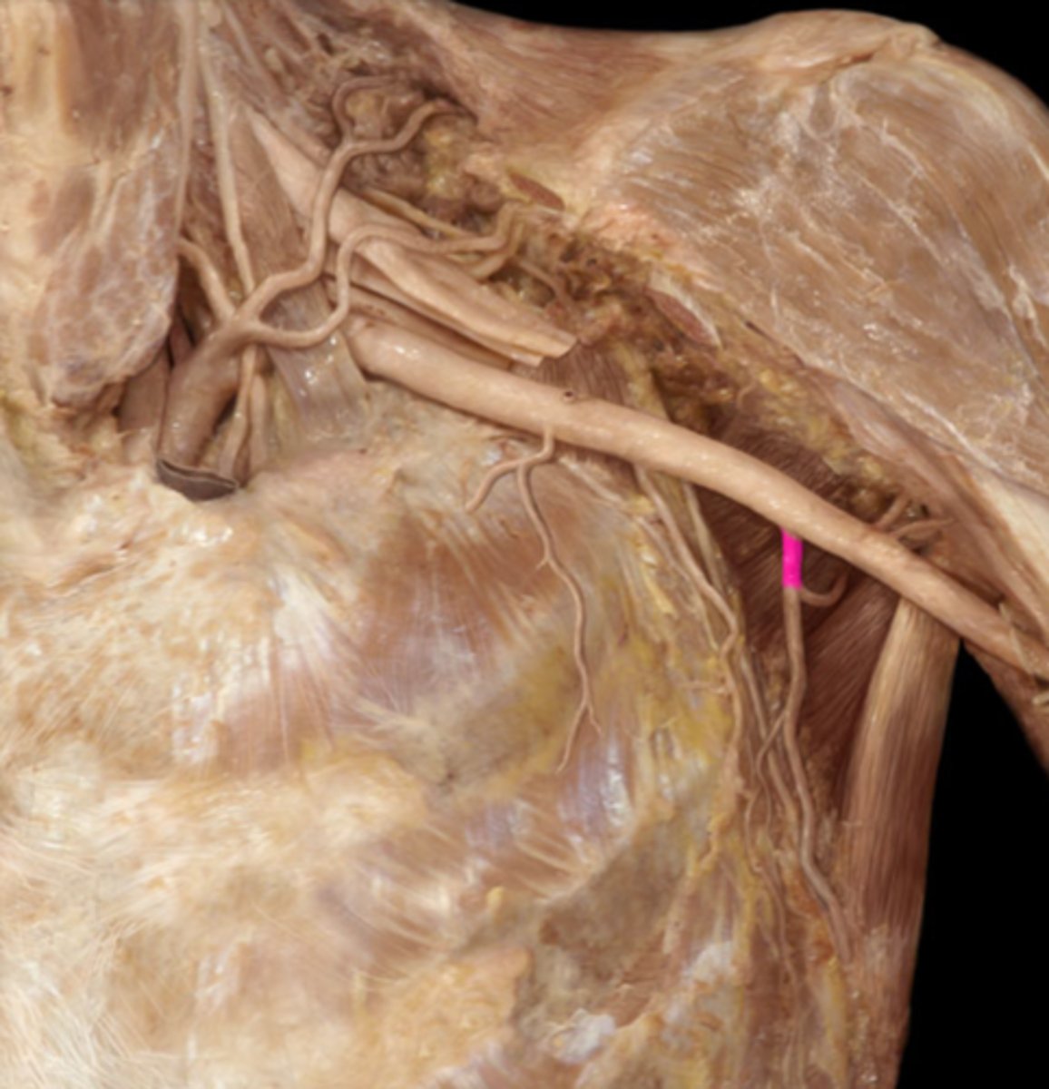 <p>Inferior border of the subscapularis along the lateral border of the scapula</p><p>- circumflex scapula and thoracodorsal arteries</p>