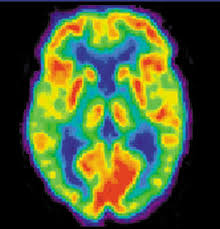 use of radioactive markers to map the chemical activity in the brain