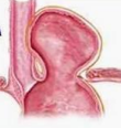 <p>union esofagogastrica abajo del diafragma pero con el fondo gastrico encima</p>