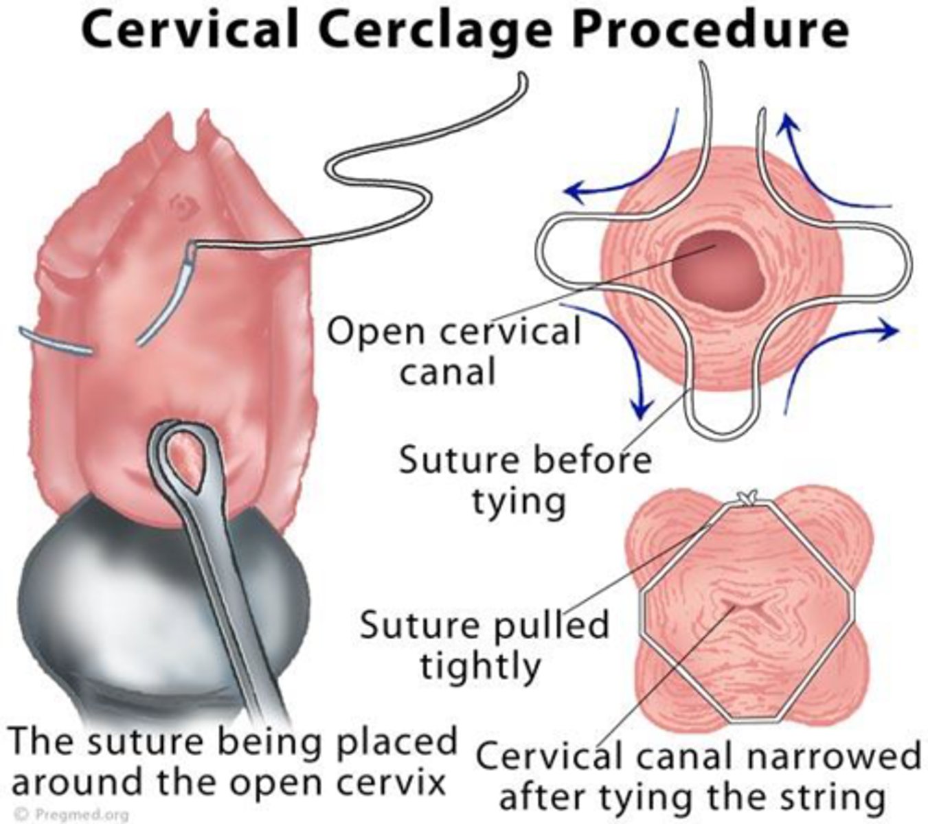 <p>cervical cerclage</p><p>continuous close observation and supervision for rest of pregnancy</p><p>report signs of preterm labour, rupture of membranes, infection</p><p>ER if strong contractions, urge to push</p>