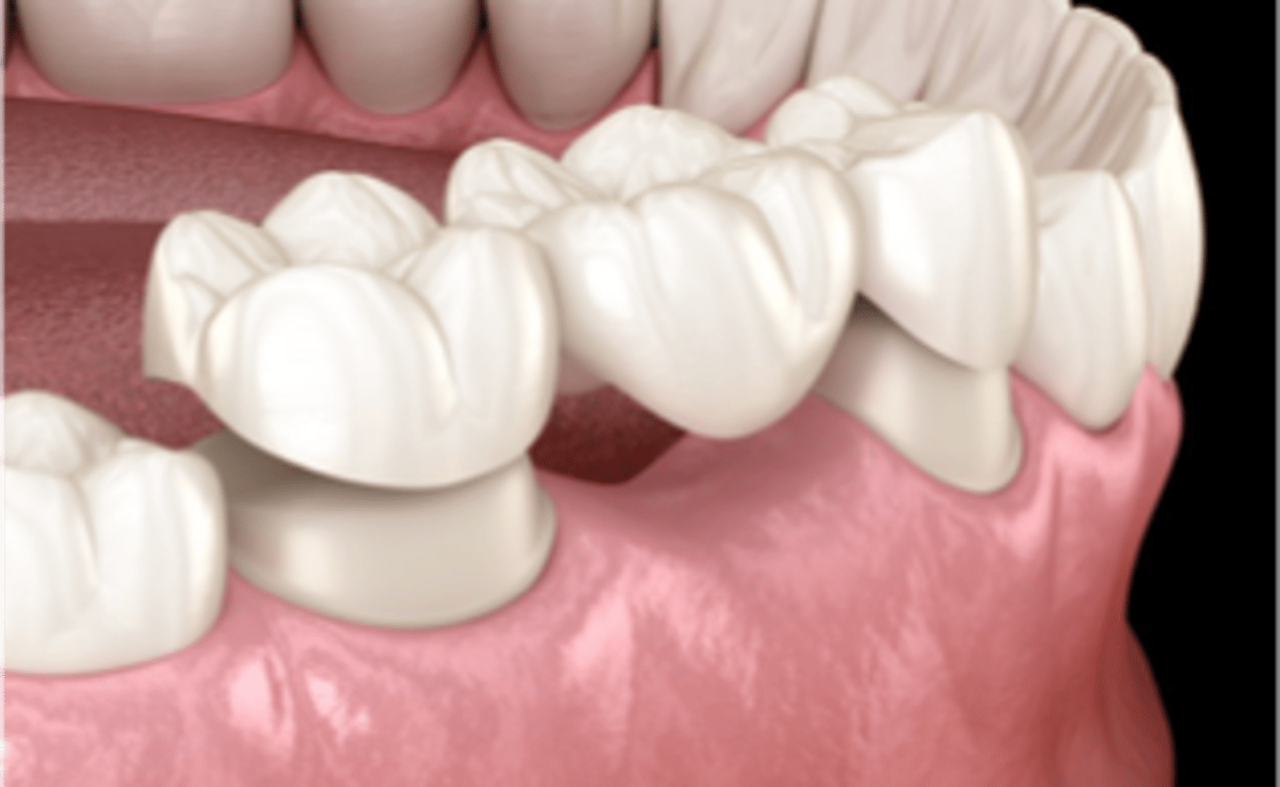 <p>any tooth or dental implant that supports a dental prosthesis</p>