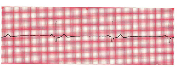 <p>The reduction in resting heart rate that accompanies training. Resting heart rate below 60 beats per minute.</p>