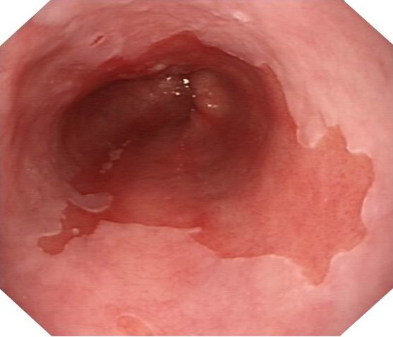 <p>What pathology is shown here?</p>